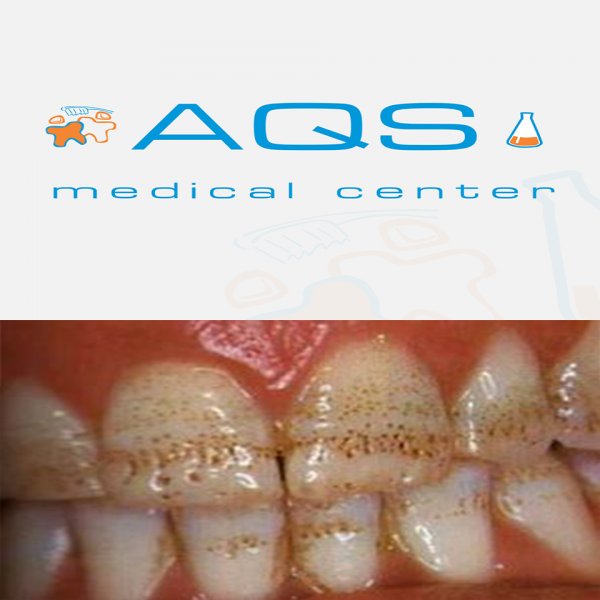 “AQS dental center” tövsiyə edir - Çilli dişlər: flüoroz