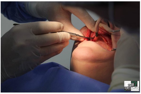İyirmi İkinci Əsr Klinikasında dişlərin implantasiyası necə edilir?