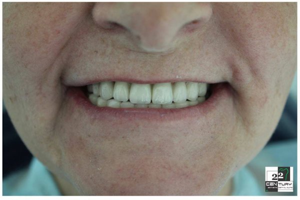 İyirmi İkinci Əsr Klinikasında dişlərin implantasiyası necə edilir?