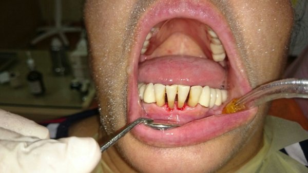 “AQS dental center” tövsiyə edir: diş ərplərindən necə xilas olmalı?