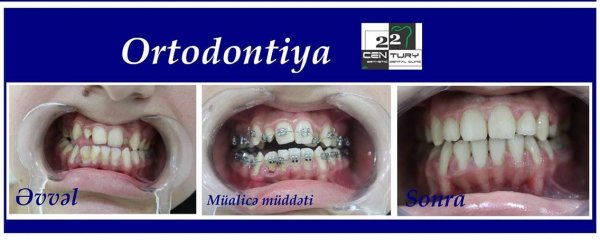 22-ci əsr klinikasında ortodontik müalicə - FOTO