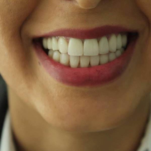 Bu dişləri seçin, çünki... - "22-ci ƏSR" Estetik Stomotoloji Klinikasının TÖVSİYƏSİ