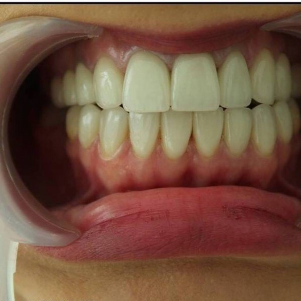 Bu dişləri seçin, çünki... - "22-ci ƏSR" Estetik Stomotoloji Klinikasının TÖVSİYƏSİ